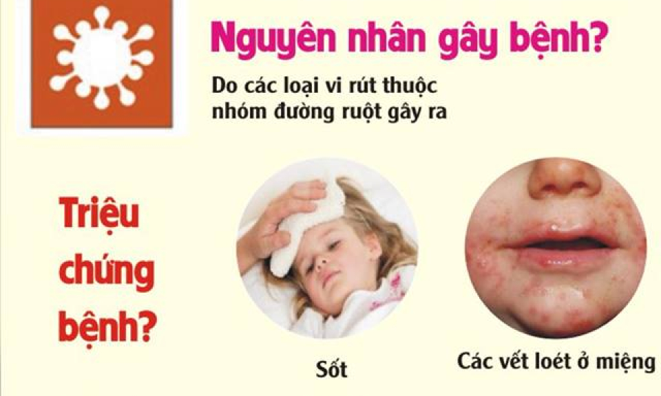 Nhận biết bệnh tay chân miệng ở trẻ khi vào mùa dịch