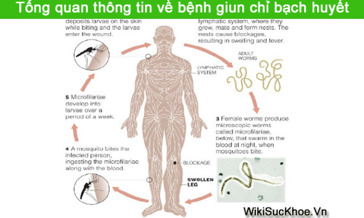 Việt Nam được công nhận loại trừ bệnh giun chỉ bạch huyết