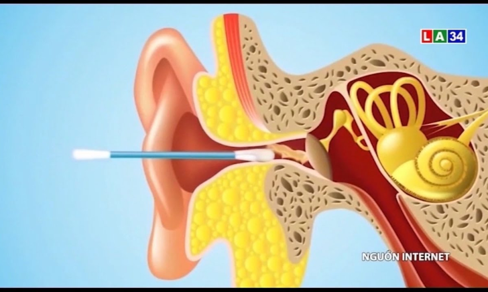 Lấy ráy tai &#8211; thói quen sai lầm và nguy hiểm