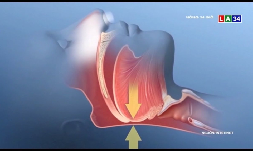 Muôn kiểu thiết bị chống ngáy liệu có hiệu quả