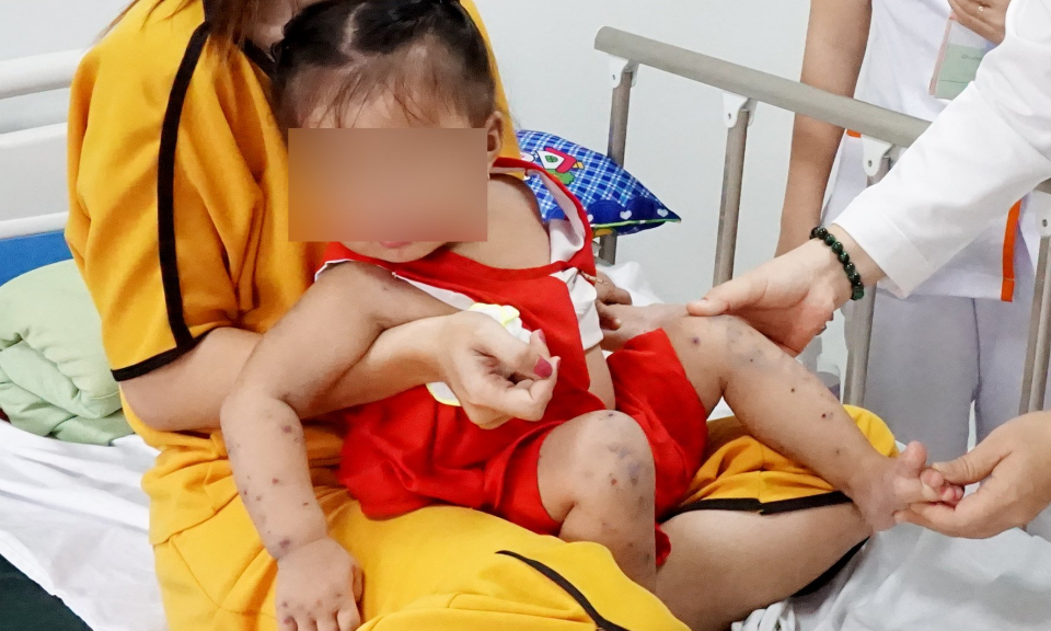 Long An ghi nhận gần 2.500 ca mắc tay chân miệng