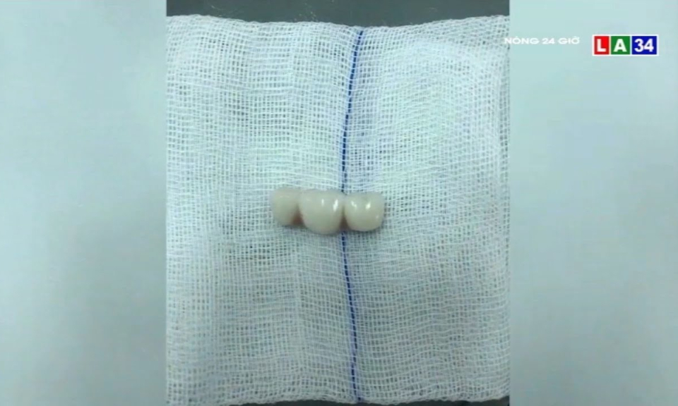 Hy hữu: Người phụ nữ nuốt luôn 4 chiếc răng giả khi ăn cơm