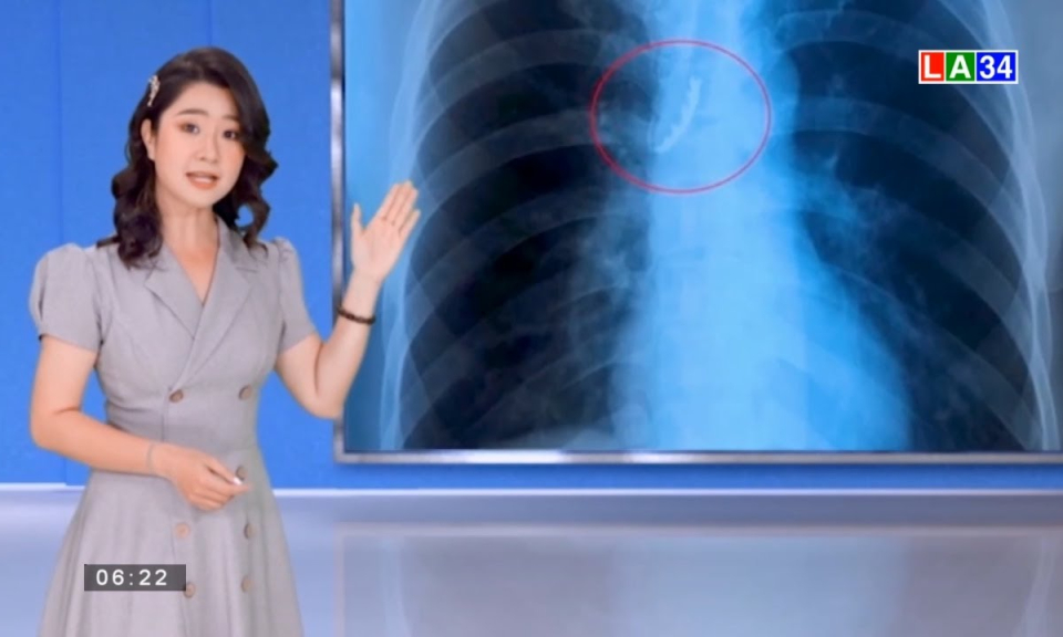 Bất cẩn, người đàn ông nuốt 4 chiếc răng giả trong lúc ho