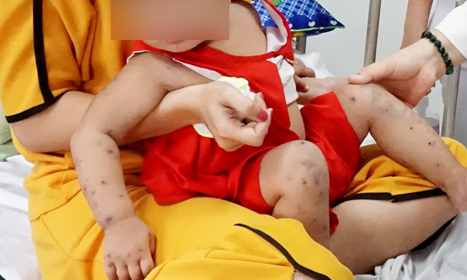 Tình hình bệnh truyền nhiễm tại Long An