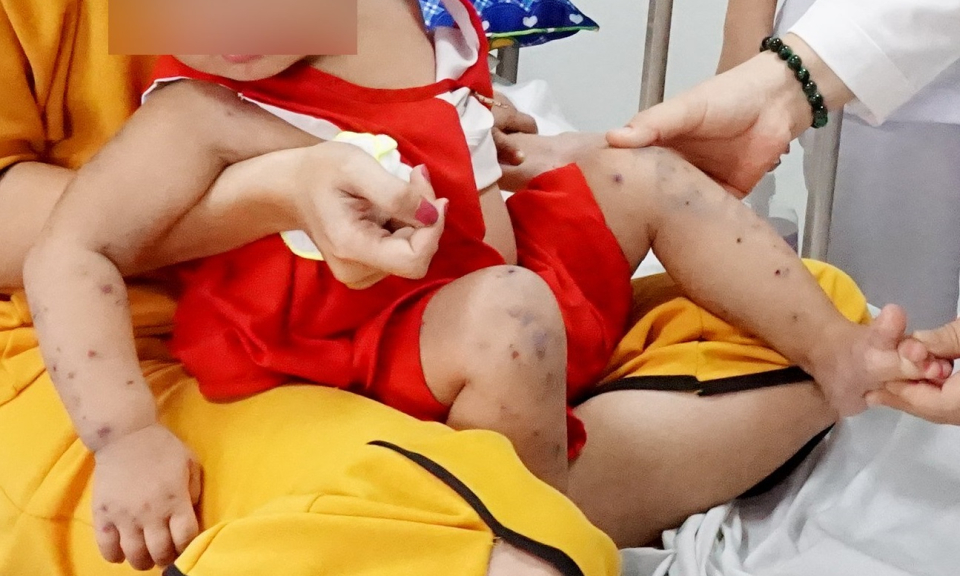 Long An số ca mắc bệnh tay chân miệng tăng gấp 13 lần so với cùng kỳ