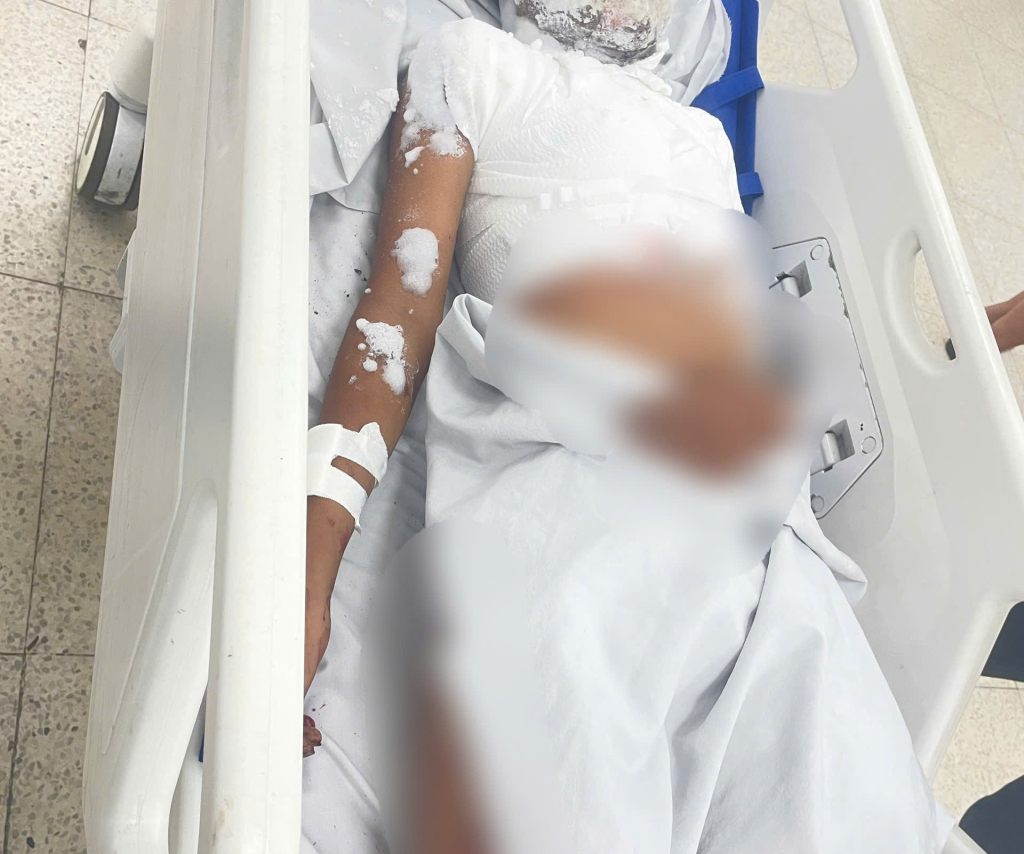 Một số trường hợp tự chế pháo nổ dẫn đến tai nạn nghiêm trọng, gây thương tích cho chính người thực hiện